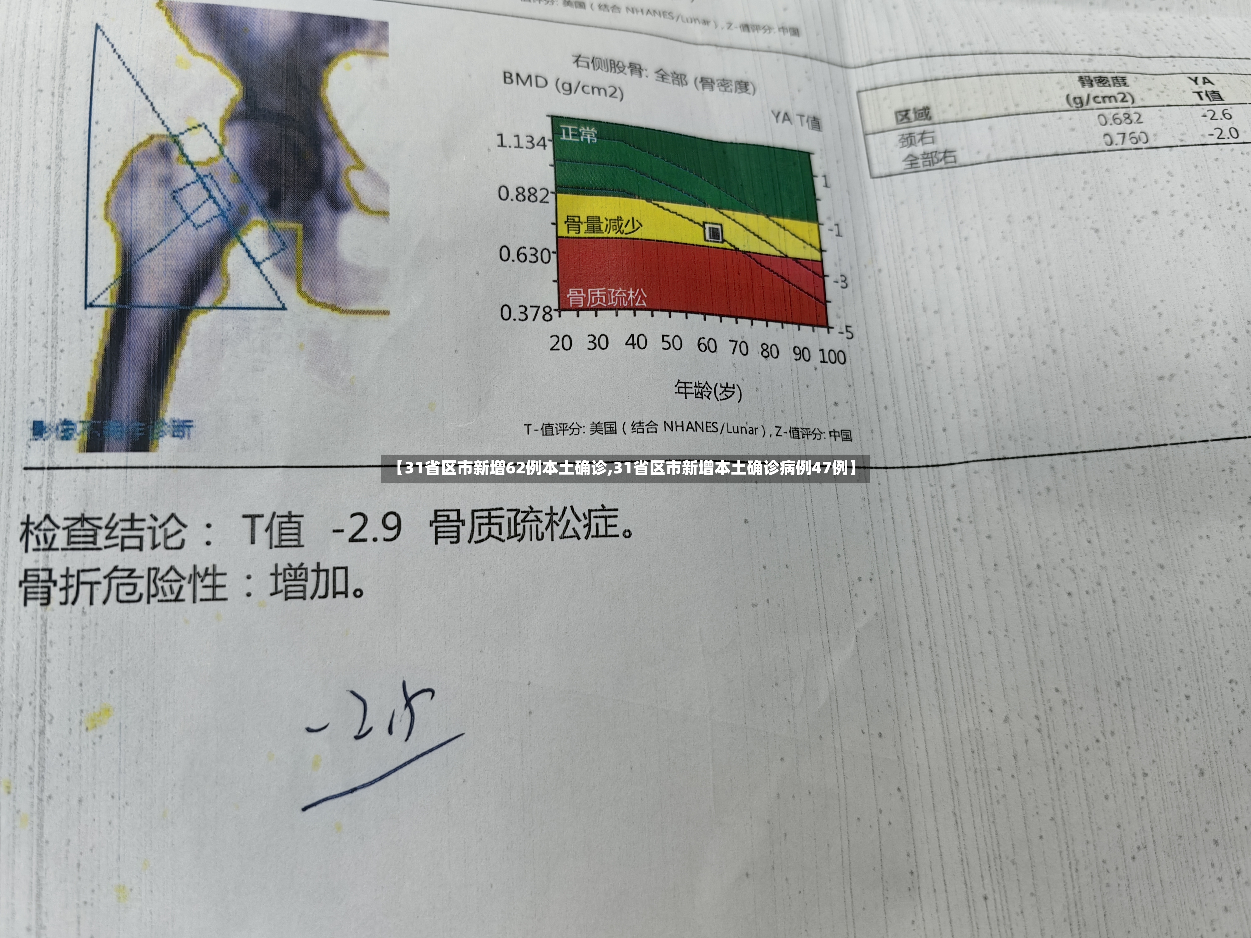 【31省区市新增62例本土确诊,31省区市新增本土确诊病例47例】-第2张图片