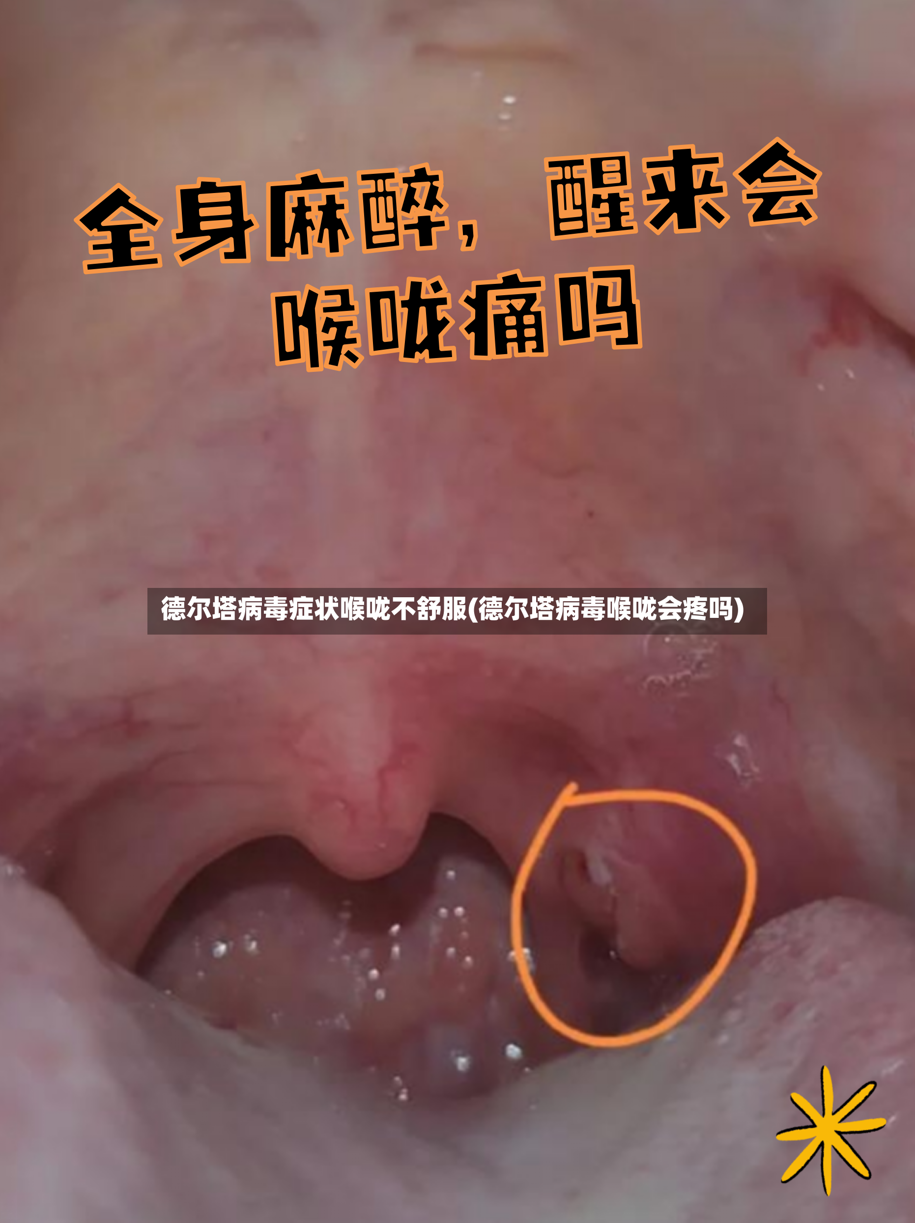 德尔塔病毒症状喉咙不舒服(德尔塔病毒喉咙会疼吗)